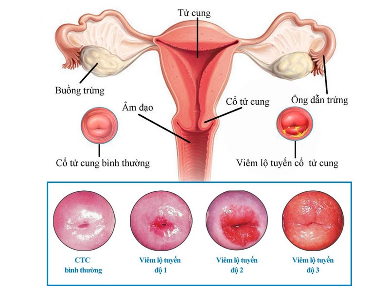Tình trạng viêm lộ tuyến cổ tử cung qua từng cấp độ